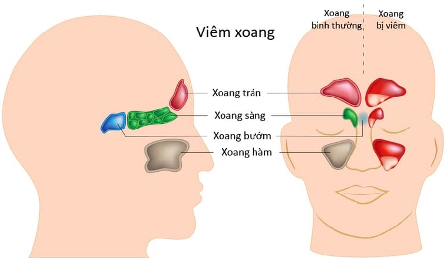 Lương y: Lê Anh Dương những lưu ý khi điều trị viêm xoang