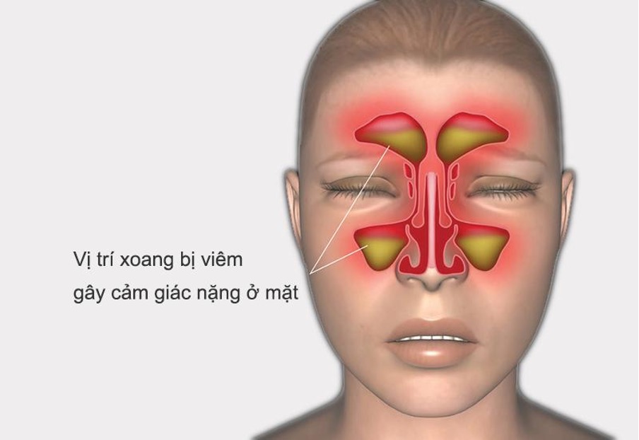 Tại sao viêm xoang khó chữa khỏi. Chia sẻ của lương y: Lê Anh Dương