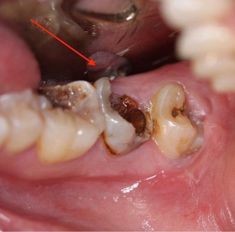 Bé Sâu Răng Khi Thay Răng Vĩnh Viễn Sẽ Hết - Những lầm tưởng của mẹ gây nguy hiểm cho con